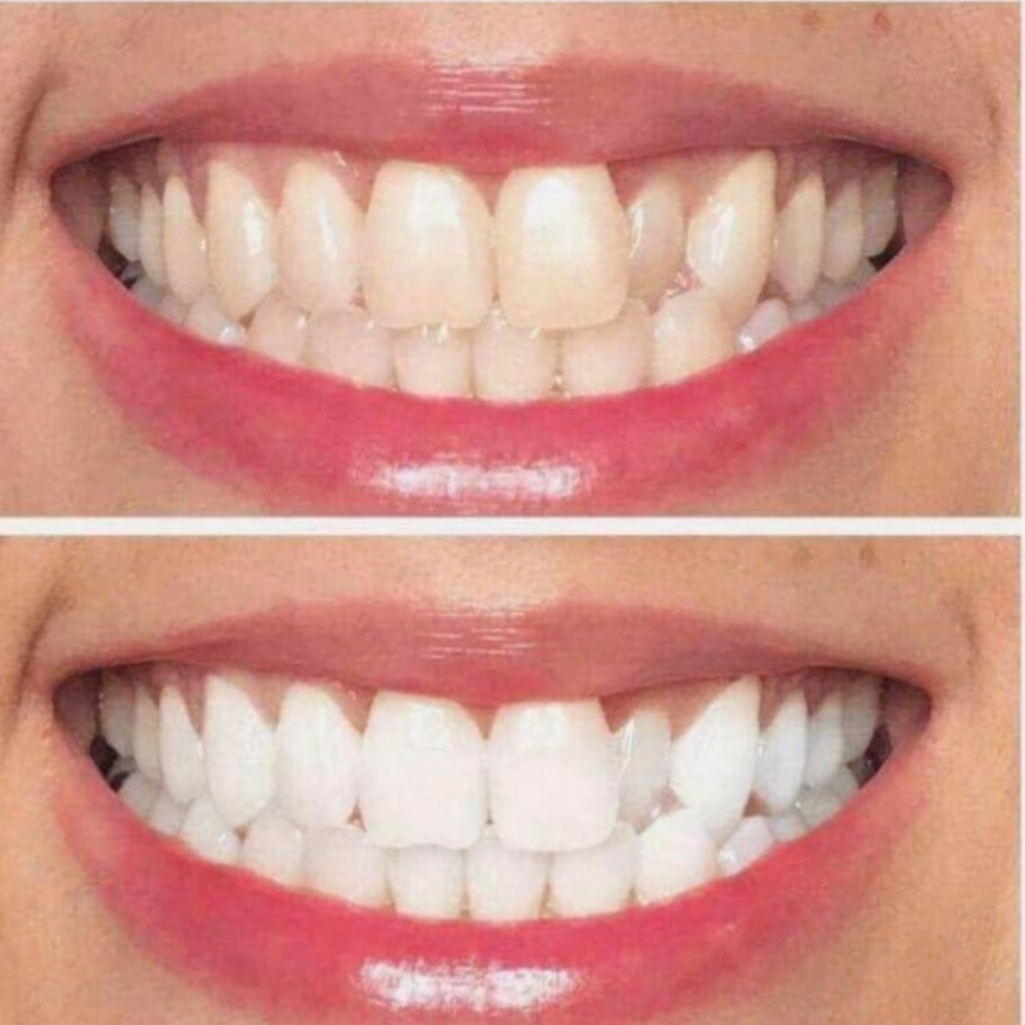 Notitie opbouwen Gepolijst SmileLin | Tanden bleken Hoogezand